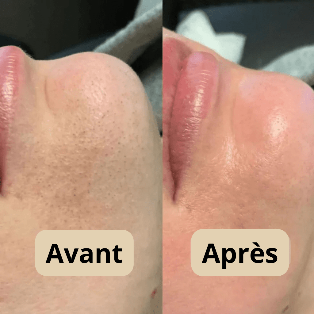 Peel Shot Coréen - Éliminé les Impuretés